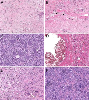 Current therapies and future prospective for locally aggressive mesenchymal tumors